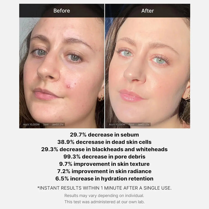 MEDICUBE Red Acne Succinic Acid Peel Serum Medicube JOLIE'S