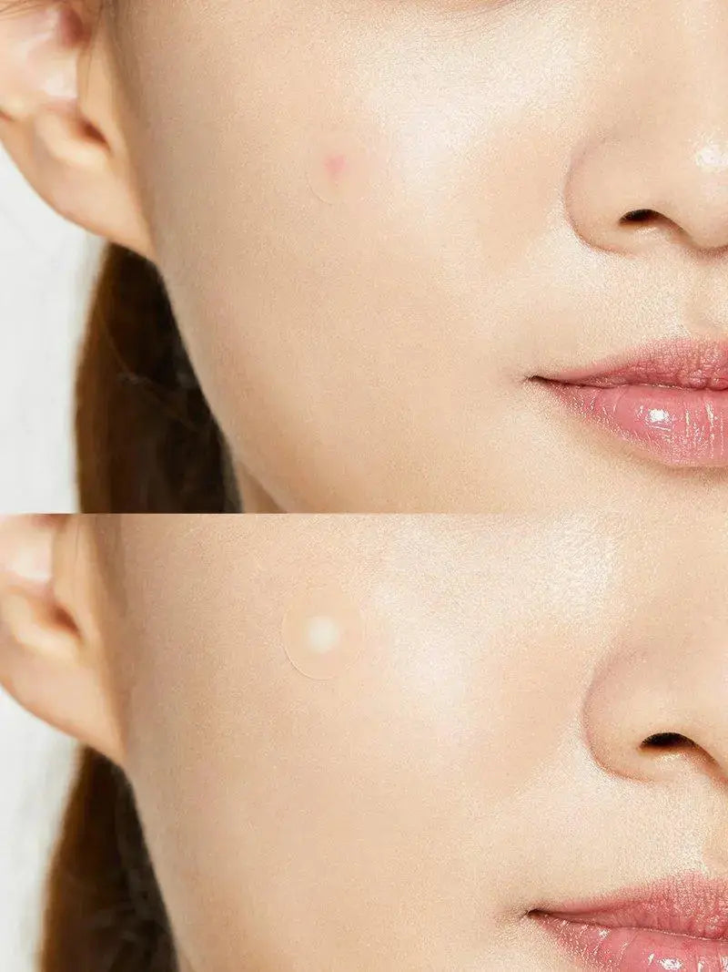 COSRX Acne Pimple Patch applied on clear skin to cover and treat a blemish, showcasing the transparent, medicated acne patch.