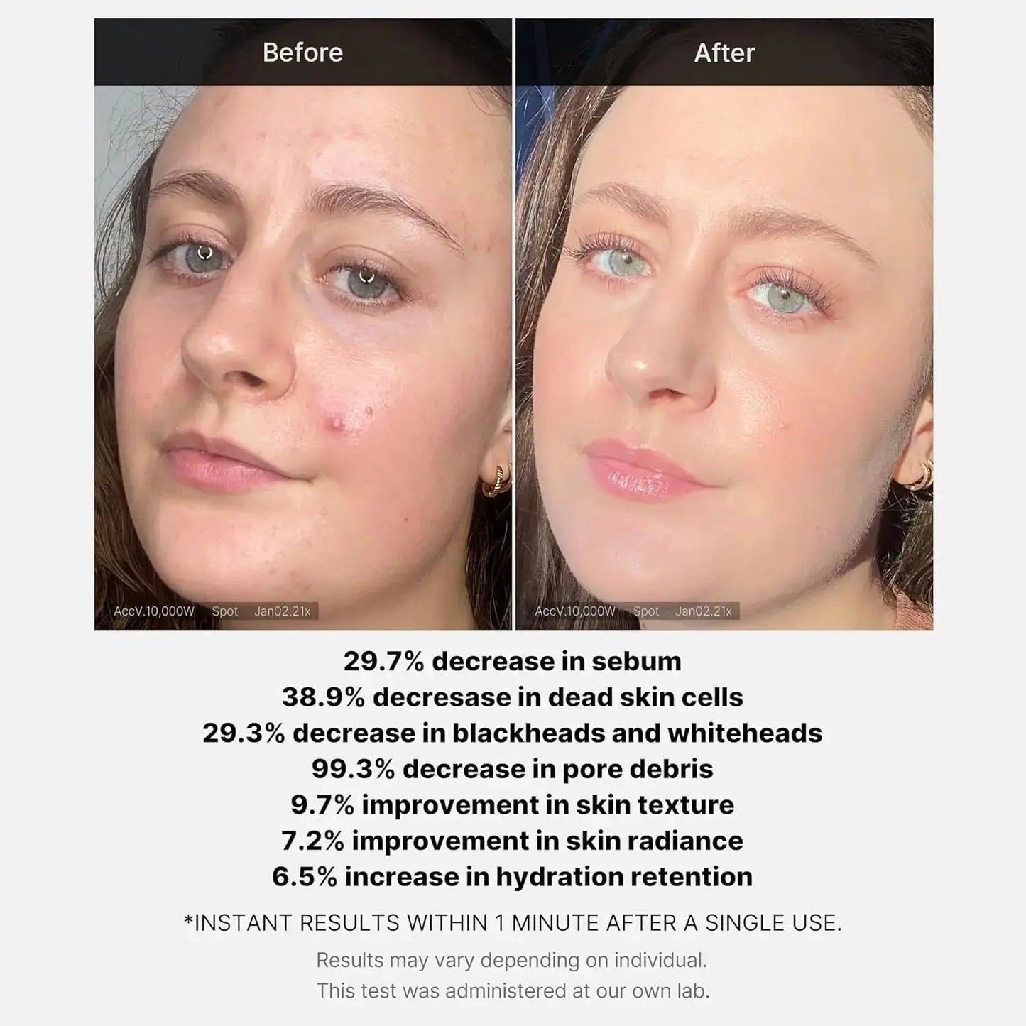 Medicube Red Acne Succinic Acid Peel Serum in a clear bottle, showing the serum's texture and dropper applicator for skincare.
